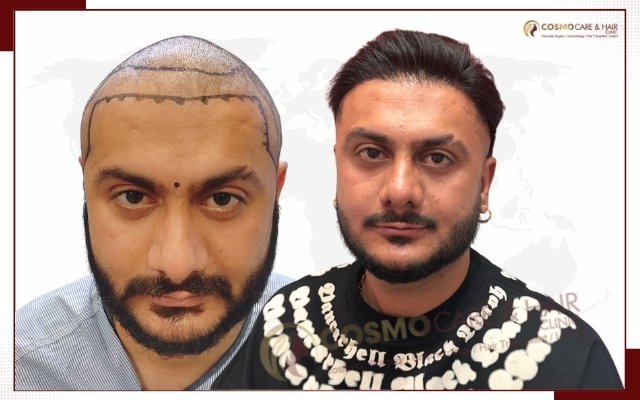 Before hair transplant, receding hairline